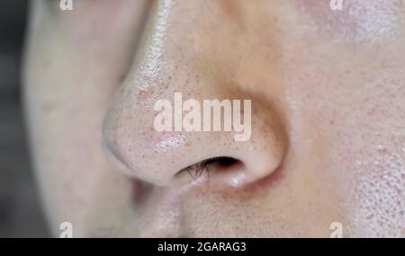 Neri o teste nere sul naso dell'uomo asiatico. Sono piccole protuberanze che appaiono sulla pelle a causa di follicoli ostruiti dei capelli. Vista in primo piano. Foto Stock