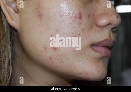 Vulgaris dell'acne e cicatrici sopra il volto intero della donna del sud-est asiatico. L'acne si verifica quando i follicoli dei capelli diventano tappati con l'olio e le cellule morte. Causa wh Foto Stock