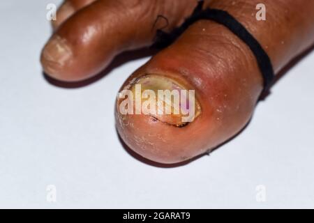 Il piede d'Atleta infezione fungina (tinea pedis) della pelle tra le dita  del piede. La forma più comune di tigna conduce a incrinato, infiammati s  Foto stock - Alamy