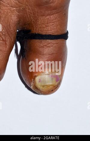 Paronichia acuta al piede grosso e pedis del piede o della linea dell'atleta fra le dita dell'uomo del Sud-est asiatico. Vista in primo piano. Foto Stock