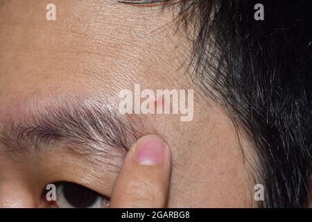 Acne meccanica o sport-indotti acne o whitehead o acne lieve a sopracciglia zona di faccia in Sudest asiatico, cinese giovane uomo. Foto Stock