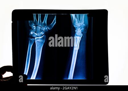 Controllo medico della radiografia esame della pellicola radiografica del braccio del paziente che punta alla frattura del raggio. Mano umana con raggi X. Raggi X delle ossa delle mani. Tecnico medico Foto Stock