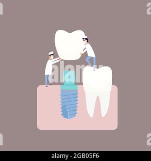 Due dentisti eseguono l'impianto dentale installare l'impianto sul moncone. Illustrazione vettoriale, in stile piatto. Poster alla clinica, immagine per le istruzioni per i dentisti, libri di formazione. Illustrazione Vettoriale