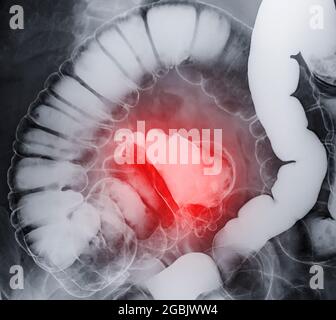 L'enema del bario ha dimostrato il cecum ed il colon per il cancro colorettale di diagnosi o il cancro del colon. Foto Stock