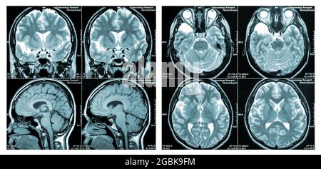 Immagine di scansione MRI di un cervello umano che mostra tutta la sclerosi multipla principale Foto Stock