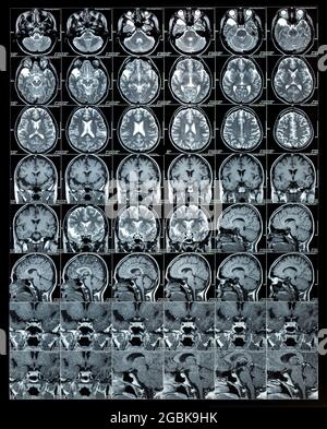 Risultati della scansione cerebrale RM o dell'immagine di risonanza magnetica, concetto di neurologia, diagnostica Foto Stock