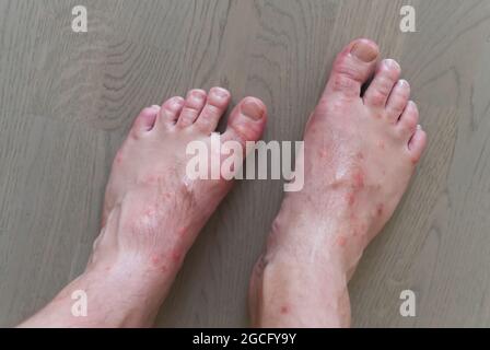 primo piano su molti morsi di zanzara sulla pelle del piede degli uomini. Foto Stock