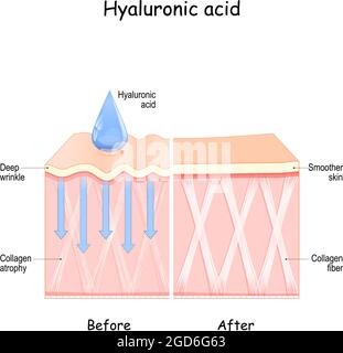 Acido ialuronico. Pelle prima e dopo l'uso di acido ialuronico. Confronto e differenza tra pelle con atrofia del collagene Illustrazione Vettoriale