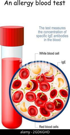 analisi del sangue allergico. Il test misura la concentrazione di anticorpi IgE specifici nel sangue. Primo piano di una provetta realistica Illustrazione Vettoriale
