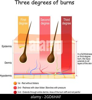 ustioni cutanee. Tre gradi di ustioni. Tipo di ferita alla pelle. Punto di ustione. Poster vettoriale Illustrazione Vettoriale