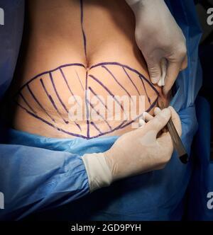 Primo piano vista dall'alto delle mani del medico utilizzando il bisturi, facendo chirurgia plastica in sala operatoria. Il chirurgo taglia la pancia del paziente con segni blu sulla pelle. Conce Foto Stock