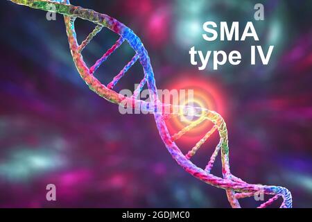 Atrofia muscolare spinale, illustrazione Foto Stock