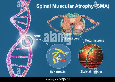 Atrofia muscolare spinale, illustrazione Foto Stock