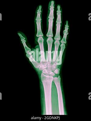 Raggi X di polso, mano e dita di un paziente maschio di 64 anni con una frattura del raggio distale Foto Stock