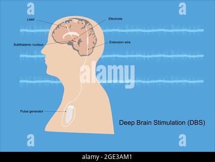 Neuromodulazione con stimolazione cerebrale profonda o DBS al nucleo subtalamico per il trattamento del morbo di Parkinson. Illustrazione delle apparecchiature mediche e. Illustrazione Vettoriale