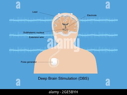 Neuromodulazione con stimolazione cerebrale profonda o DBS al nucleo subtalamico per il trattamento del morbo di Parkinson. Illustrazione delle apparecchiature mediche e. Illustrazione Vettoriale