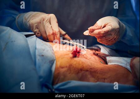 Primo piano delle mani del medico in guanti sterili che mettono suture dopo l'intervento di pancia del tuck. Chirurgo che esegue chirurgia plastica addominale in sala operatoria. Concetto di abdominoplastica e chirurgia estetica. Foto Stock