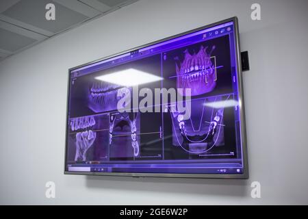 Schermo TV in uno studio dentistico con raggi X dei denti del paziente. Foto Stock