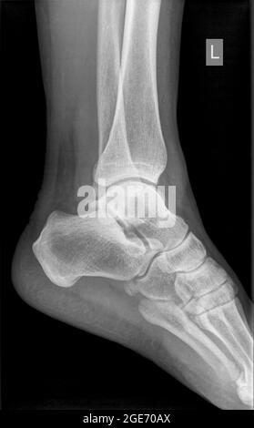 Radiografia di una caviglia di una paziente di 53 anni con un malleolo mediale fratturato. Vista laterale Foto Stock