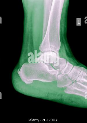 Radiografia di un maschio di 50 anni di caviglia con tibia distale fratturata. Vista laterale Foto Stock