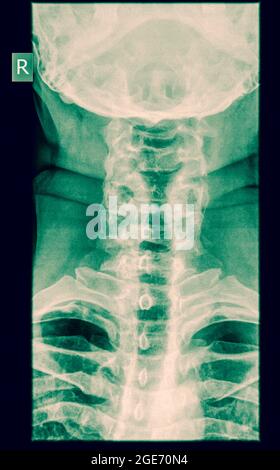 Colonna cervicale x-ray con fratturato una tane. Un maschio di 50 anni paziente vista anteriore Foto Stock