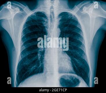 Radiografia normale del torace sano di un maschio di 36 anni. Vista frontale Foto Stock