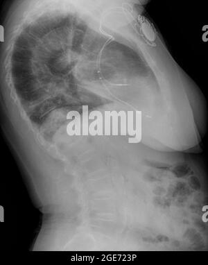 radiografia toracica di una paziente di 82 anni con un pacemaker Foto Stock