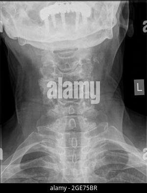 Radiografia della colonna cervicale di una vista frontale di una paziente di 72 anni Foto Stock