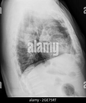 Radiografia normale del torace sano di una vista laterale maschile di 63 anni Foto Stock