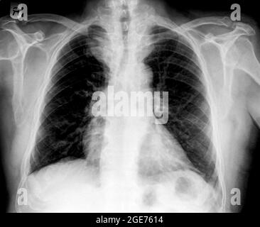 Radiografia normale del torace sano di un maschio di 63 anni. Vista frontale Foto Stock