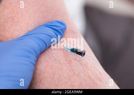 Catetere posizionato nella vena di un paziente Foto Stock