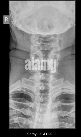 Colonna cervicale x-ray con fratturato una tane. Un maschio di 50 anni paziente vista anteriore Foto Stock