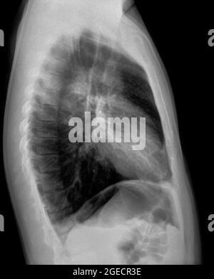 Radiografia normale del torace sano di un maschio di 36 anni. Vista laterale Foto Stock