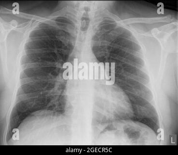 Radiografia normale del torace sano di un maschio di 46 anni. Vista frontale Foto Stock