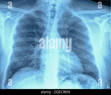 Radiografia normale del torace sano di un maschio di 46 anni. Vista frontale Foto Stock