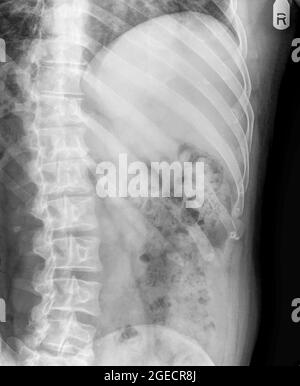 Frattura del numero 10 nervatura può essere visto in una radiografia del torace di un 36 enne maschio. vista frontale Foto Stock
