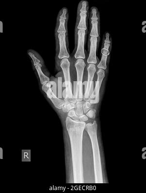Raggi X di polso, mano e dita di un paziente maschio di 64 anni con una frattura del raggio distale Foto Stock