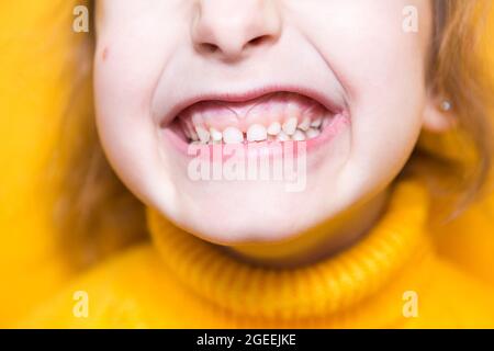 Ragazza mostra i denti-morso patologico, malocclusione, overbite. Odontoiatria pediatrica e parodontica, correzione del morso. Salute e cura dei denti, carie Foto Stock