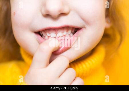 Ragazza mostra i denti-morso patologico, malocclusione, overbite. Odontoiatria pediatrica e parodontica, correzione del morso. Salute e cura dei denti, carie Foto Stock