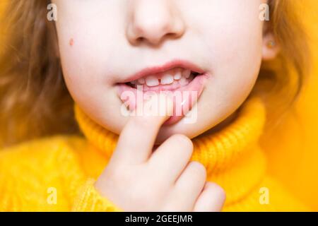 Ragazza mostra i denti-morso patologico, malocclusione, overbite. Odontoiatria pediatrica e parodontica, correzione del morso. Salute e cura dei denti, carie Foto Stock