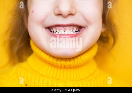 Ragazza mostra i denti-morso patologico, malocclusione, overbite. Odontoiatria pediatrica e parodontica, correzione del morso. Salute e cura dei denti, carie Foto Stock