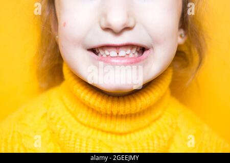 Ragazza mostra i denti-morso patologico, malocclusione, overbite. Odontoiatria pediatrica e parodontica, correzione del morso. Salute e cura dei denti, carie Foto Stock