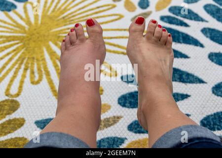 Gonfiore del piede sinistro dopo pungiglione sul piede femminile Foto Stock