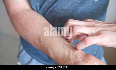 Nan graffia l'avambraccio a mano con prurito cutaneo Foto Stock