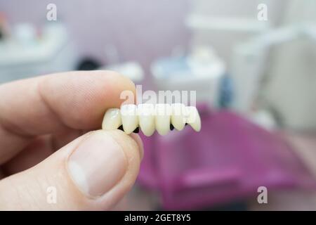 ponti dentali in ceramica metallica nelle mani di un medico Foto Stock