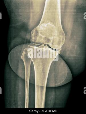 raggi x del ginocchio destro di un maschio di 65 anni Foto Stock