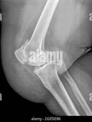 raggi x del ginocchio destro di un maschio di 65 anni Foto Stock