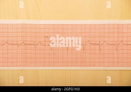 Risultati dei test ECG su carta millimetrica, risultati del ritmo cardiaco, primo piano dei dettagli del grafico ECG Foto Stock