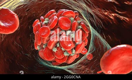 Coagulo di sangue, illustrazione. Foto Stock