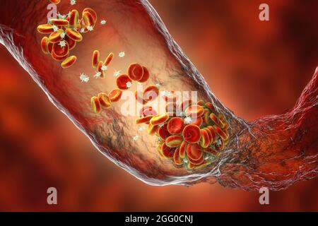 Coagulo di sangue, illustrazione. Foto Stock